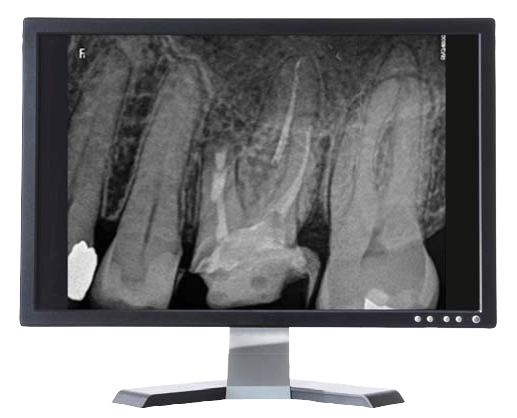 Carestream-RVG-6200-Aufnahme im Monitor